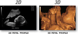 2D and 3D
fetal profile